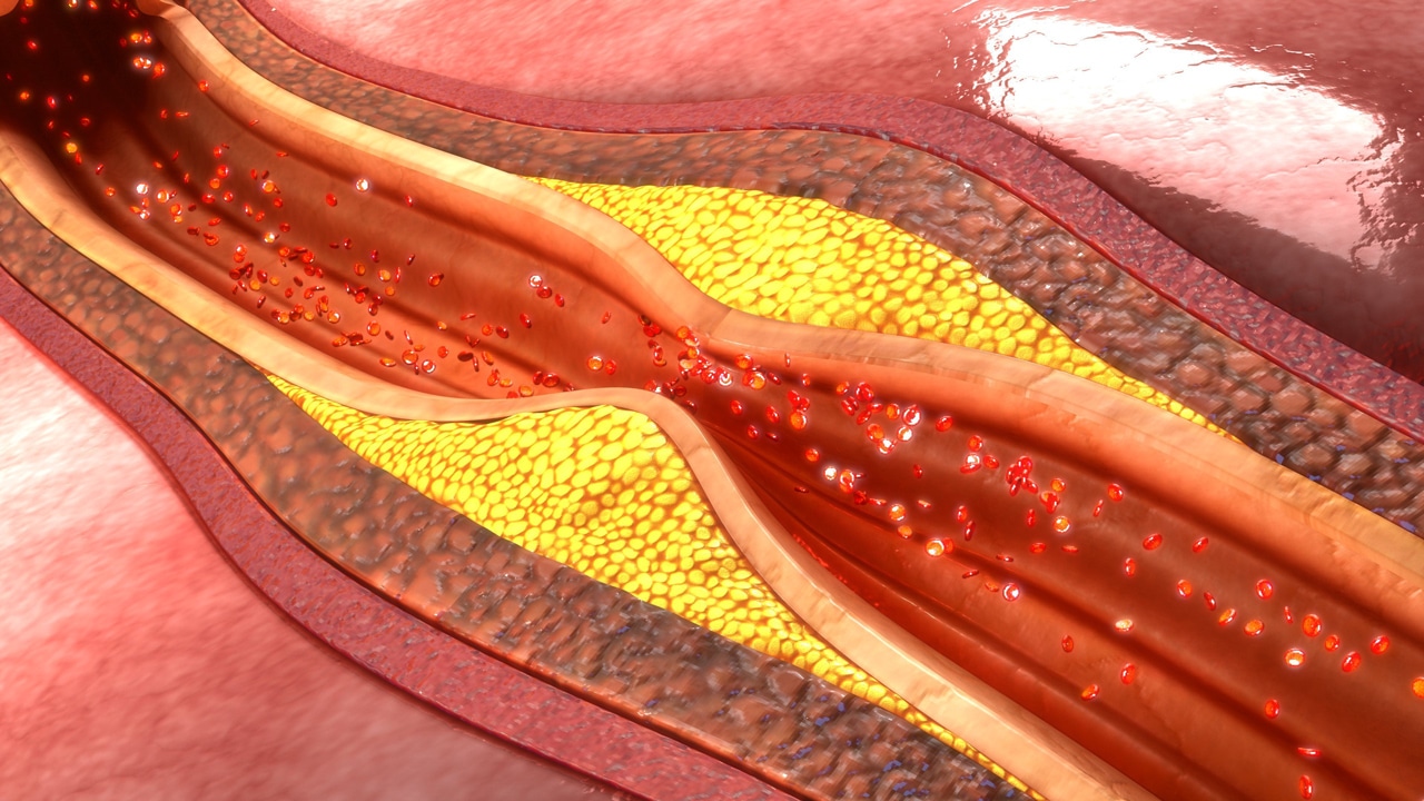 Ein verengtes Blutgefäß durch einen zu hohen Cholesterinspiegel