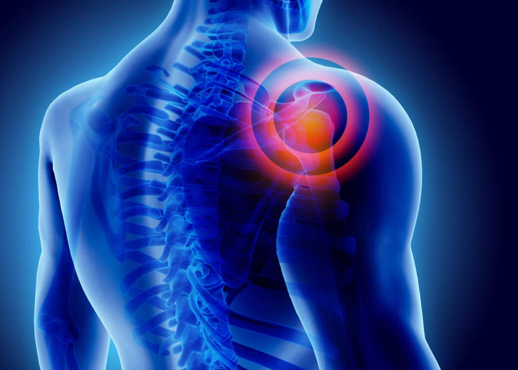 Eine Grafik eines Schmerzes bei der Schulter